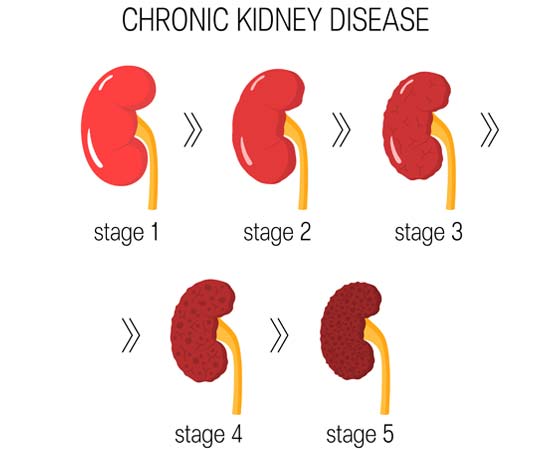 ckd stages